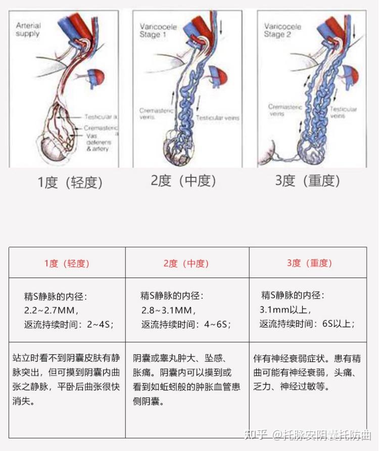 精索靜脈曲張三個程度圖詳解，精索靜脈曲張三個程度詳解圖解