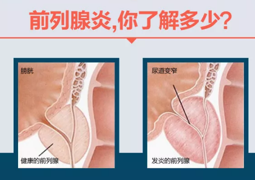 前列腺炎的治愈可能性，理解與探索，前列腺炎的治愈可能性，深入理解與探索