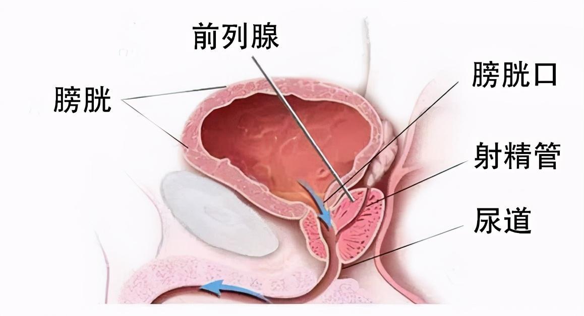 前列腺炎治療周期詳解，前列腺炎治療周期全面解析