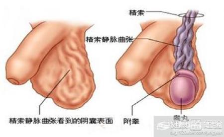 精索靜脈曲張可以自愈嗎？解析與探討，精索靜脈曲張能否自愈？解析與探討